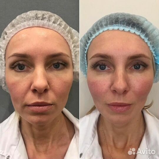 СМАС лифтинг