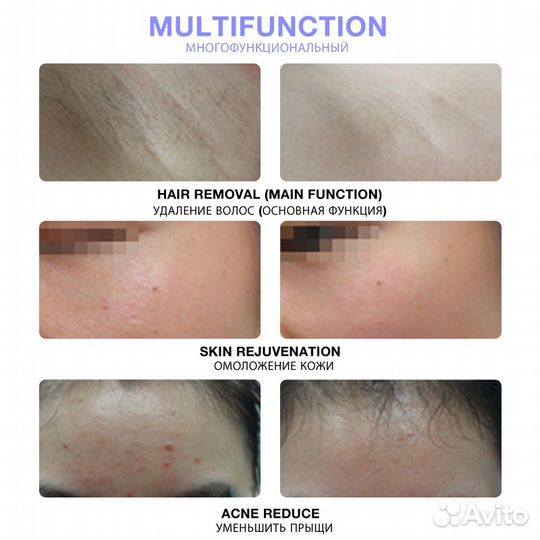 Безболезненный лазерный эпилятор