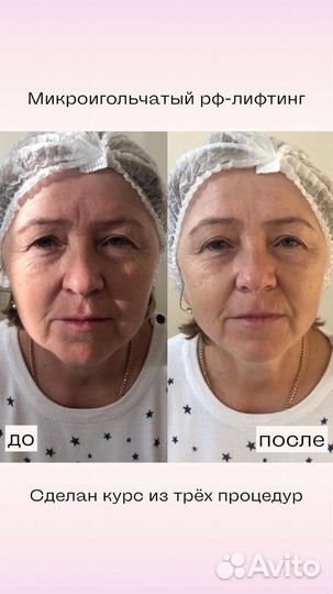Микроигольчатый RF лифтинг