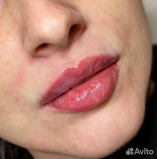 Биоревитализация