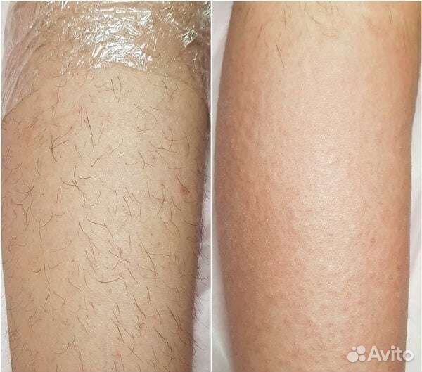 Электроэпиляция