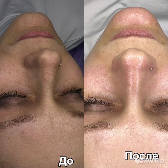 Косметолог/чистка лица/пилинг