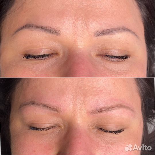 Лазерное удаление татуажа