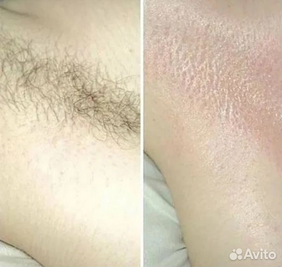 Эпиляция,депиляция: мужчин и женщин