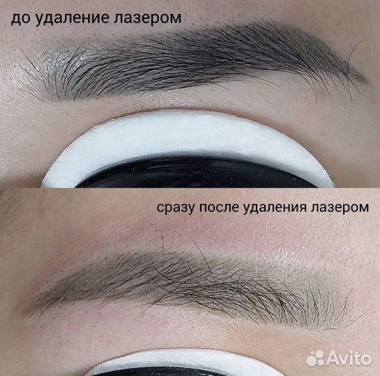 Удаление татуажа лазером