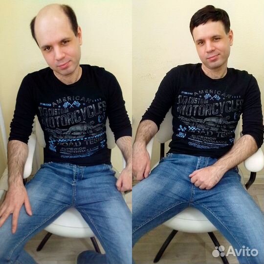 Помощь при алопеции - Системы замещения волос