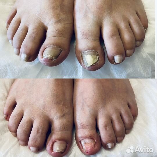 Подолог.Профессиональный педикюр. Срочный заказ