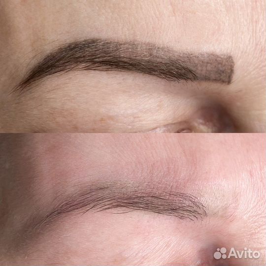 Удаление татуажа и тату лазером требуются модели