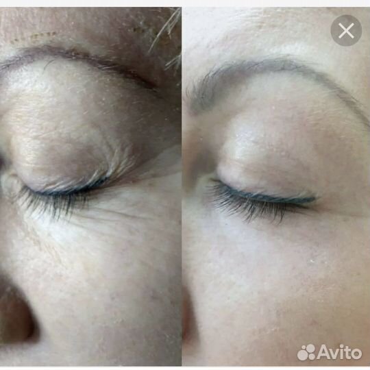 Безоперационная блефаропластика