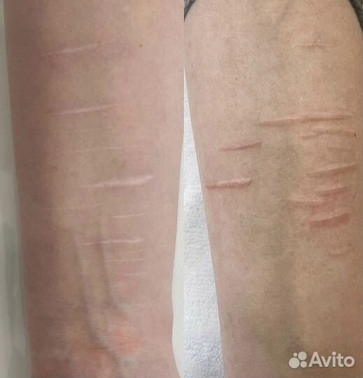 Камуфляж рубцов/растяжек/ареол