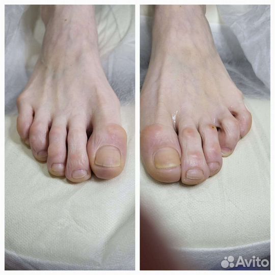 Лечебный педикюр подолог