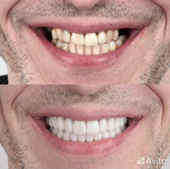 Моделировка в exocad