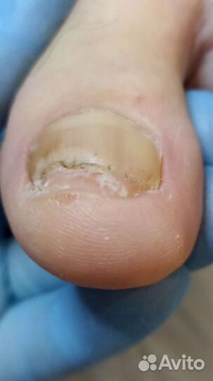 Медицинский педикюр, педикюр