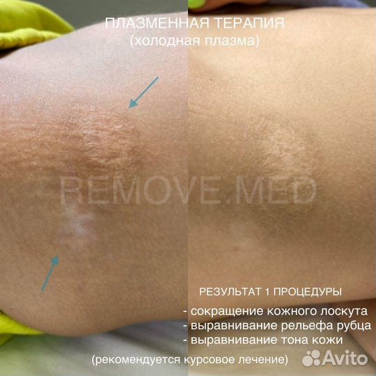 Холодная плазма процедуры обучение