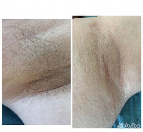 Депиляция воском: глубокое бикини