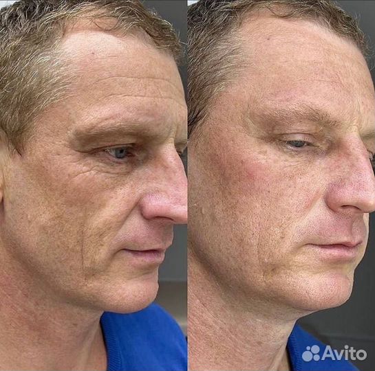 Модель на лифтинг аппаратом Ультраформер 3