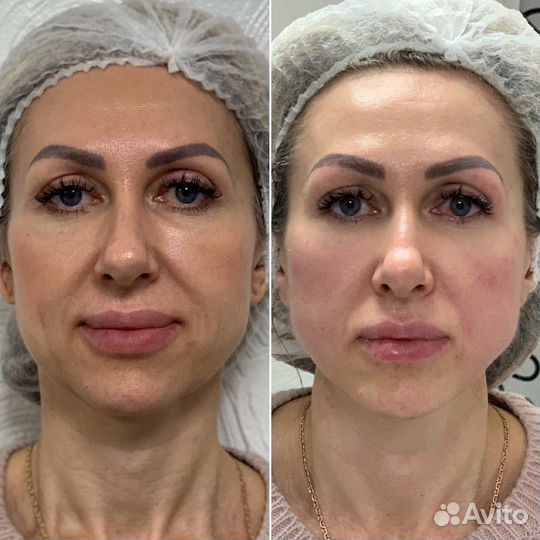 Модель на смас лифтинг\рф игольчатый/рф лифтинг