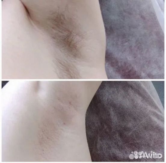 Шугаринг