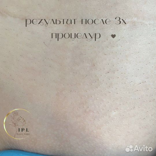 Фотоэпиляция: глубокое бикини