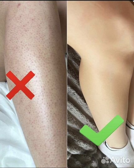 Элос эпиляция