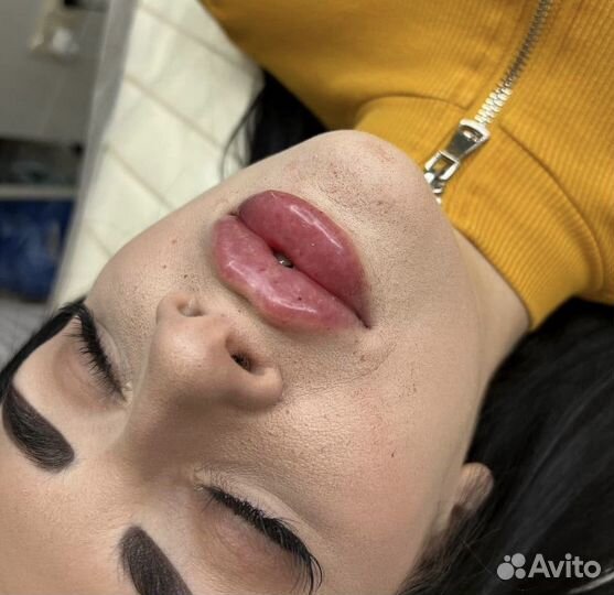 Модель на увеличение губ