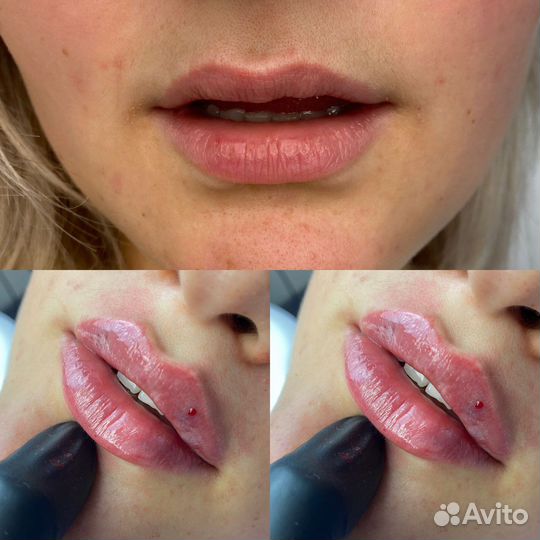 Увеличение губ