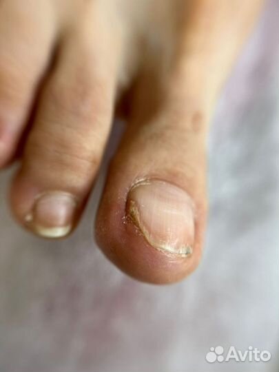 Лечебный педикюр подолог