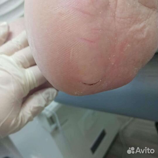 Коррекция вросшего ногтя