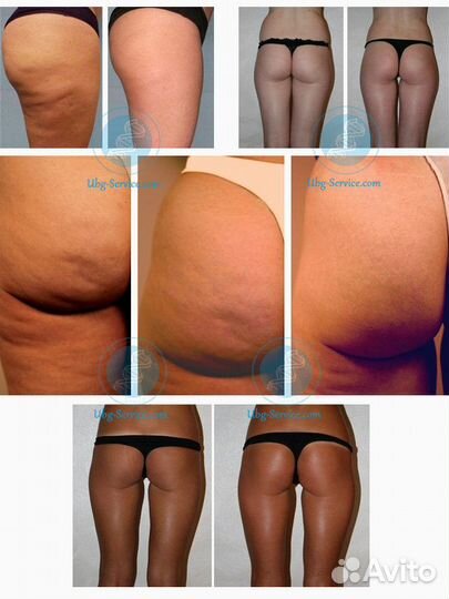 Дерматония- Вибрационный массаж Турбо G5