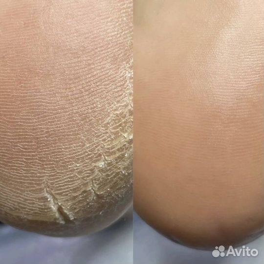 Педикюр Smart, Golden Trace