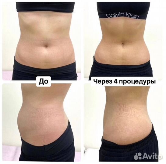 Липолитики тело похудение худое лицо