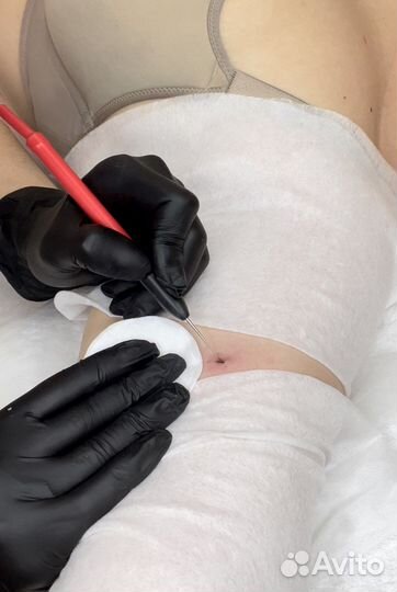 Удаление папиллом, родинок, бородавок