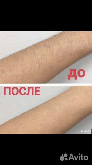 Элос-эпиляция: глубокое бикини