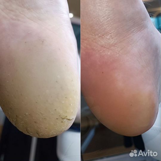 Педикюр подолог