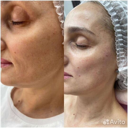 РФ лифтинг пробный сеанс