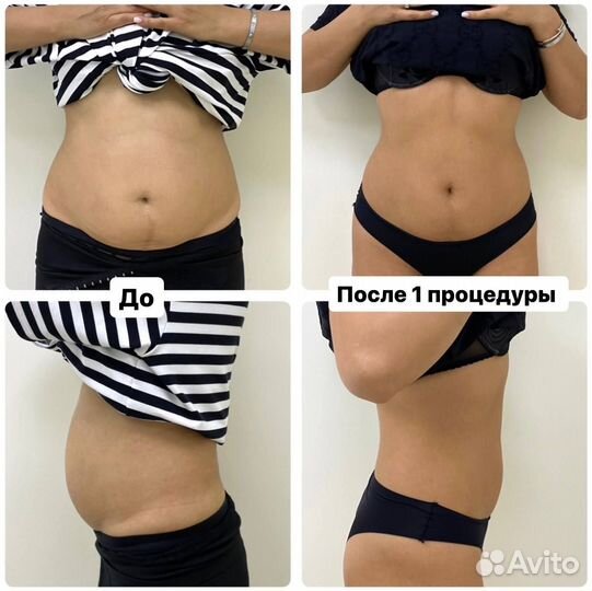 Липолитики тело похудение худое лицо