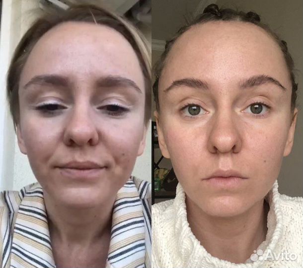 Омоложение лица