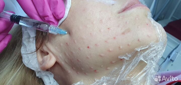Увеличение губ, мезо, био, ботокс