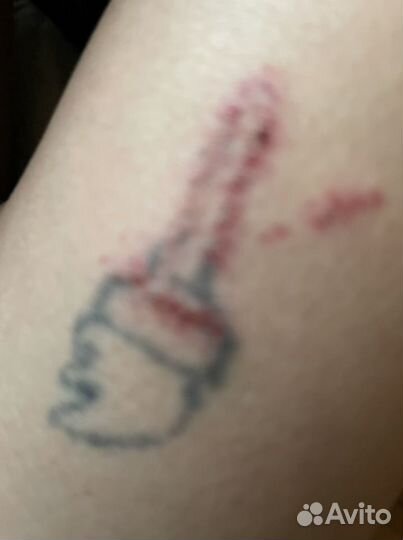 Лазерное удаление бородавок, попилом, эпиляция