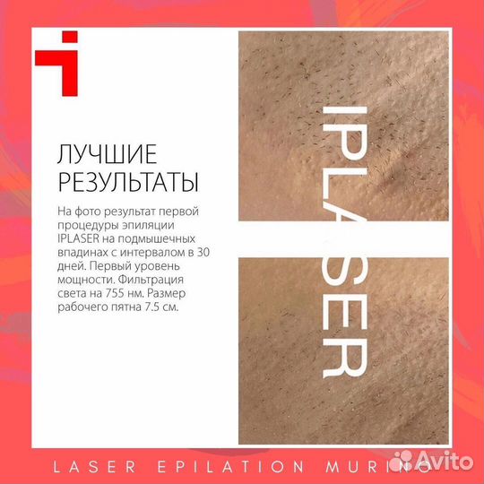 Лазерная эпиляция метро Девяткино