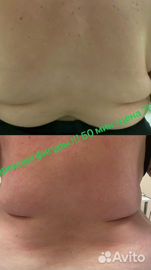 Ультразвуковая кавитация,аппаратный RF массаж