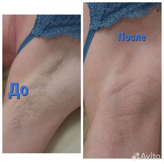 Шугаринг /Депиляция воском/Челябинск Северо запад