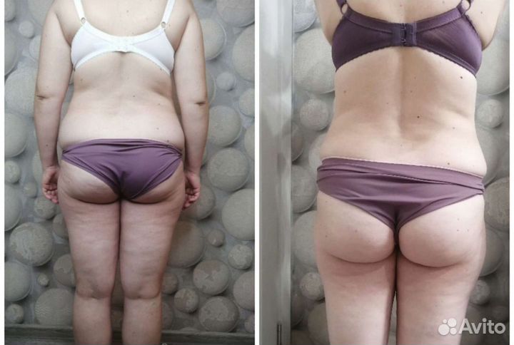 Аппаратный массаж коррекция фигуры