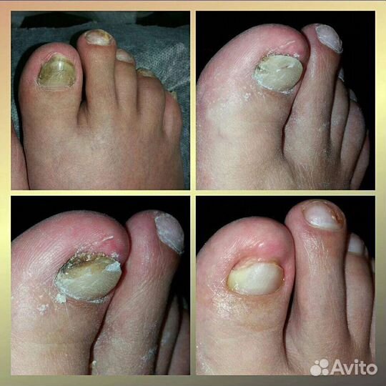 Педикюр любой сложности