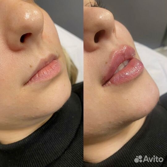 Модель на увеличение губ, углы Джоли