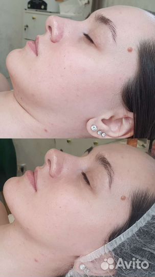 Косметолог, аппаратная косметология, шугаринг