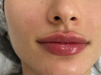 Контурная пластика губ. Опытный косметолог