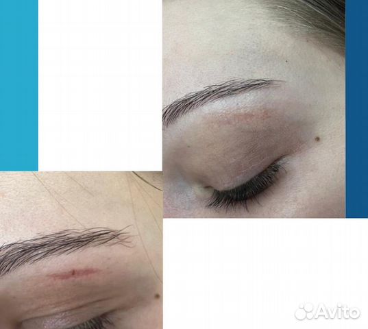 Удаление шрамов и рубцов