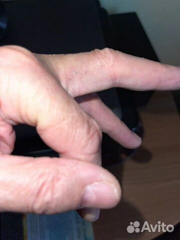 Лазерное удаление бородавок, попилом, эпиляция