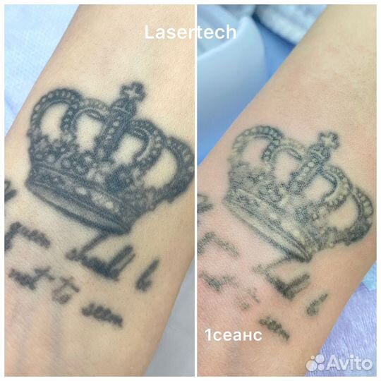 Удаление татуировки. Бесплатно